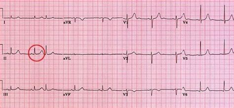 Cardiac Complexes, Premature; Ectopic Heartbeats; Extrasystole; Premature Beats; Premature ...