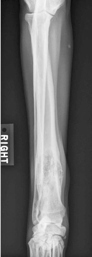 Case study: canine osteosarcoma