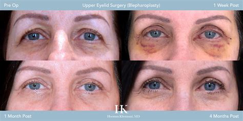 Things to Do to Prepare for Easy Recovery From Eyelid Surgery - Ulrich ...