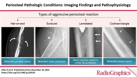 Periosteal Pathologic Conditions: Imaging Findings and Pathophysiology ...