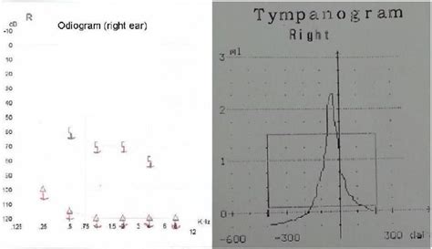 The audiogram and tympanogram after trauma. | Download Scientific Diagram