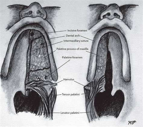 12 Cleft palate repair: The Furlow double-opposing Z-plasty, the Von Langenbeck palatoplasty ...