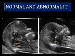 Abnormal Nuchal Translucency Ultrasound