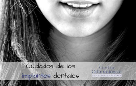 Cuidado de los implantes dentales | Dr. Santiago Casanova