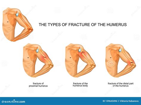 Humerus Fracture, Trauma, Surgery Stock Vector - Illustration of orthopedic, collarbone: 139643496