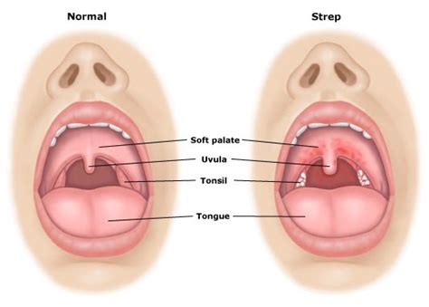 Sinus infection Coughing Up Bloody Mucus - TondahtyuiMcfall