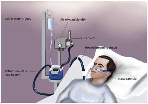 JCM | Free Full-Text | High-Flow Oxygen Therapy in the Perioperative Setting and Procedural ...