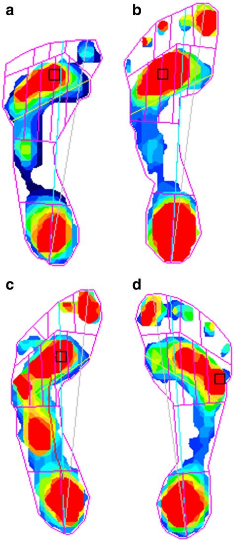 Dynamic pedobarograms of four patients with Moebius. Patient no. 2 (a)... | Download Scientific ...