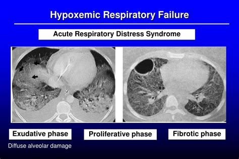 PPT - Acute Respiratory Failure PowerPoint Presentation, free download ...