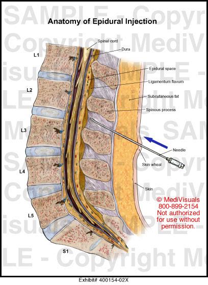 Anatomy of Epidural Injection Medical Illustration Medivisuals