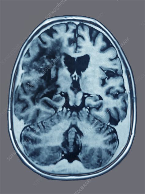 Astrocytoma Mri - Stock Image - C021/3873 - Science Photo Library