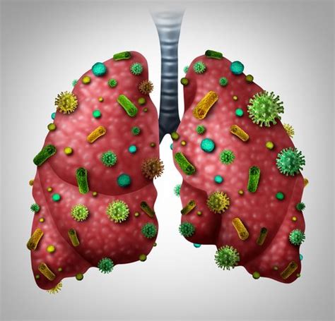 MAC Lung Infections in CF Best Treated When Specific Bacterial Species ...