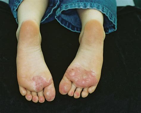 Juvenile plantar dermatosis