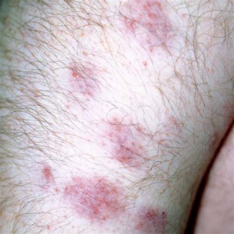 Sarcoidosis Picture from UI Dermatology (Hardin MD / uIowa.edu)