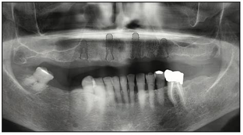 Ceramic Implants and Dental Implant Rehabilitation, Part 2 - Dentistry Today