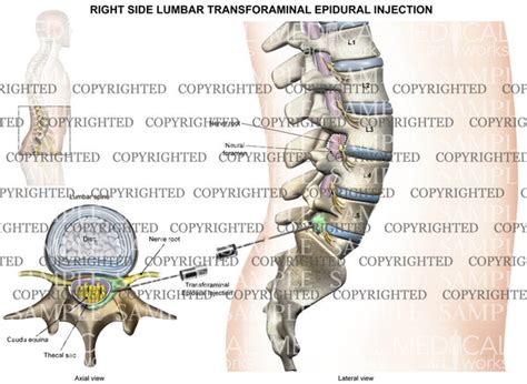 L5-S1 Right side lumbar transforaminal epidural injection - Male ...