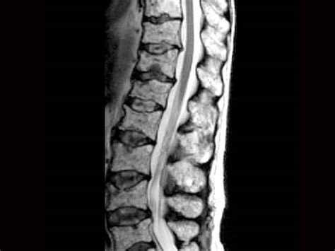 'Practice Changing' MRI Recommendations in Multiple Myeloma