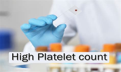 When to Worry About High Platelet Count - HealthTeps