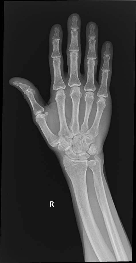 Triquetral bone fracture | Image | Radiopaedia.org