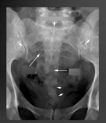 sacrum x ray: AP view Diagram | Quizlet