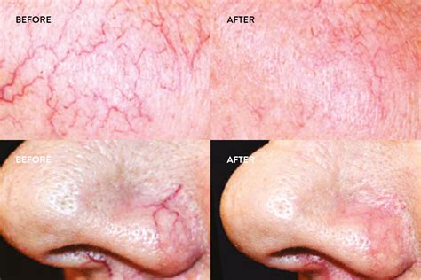 Thread Vein Removal (Face & Leg) – A Vita