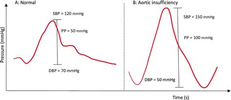 Corrigan’s pulse: a clinical diagnosis of aortic regurgitation | BMJ ...