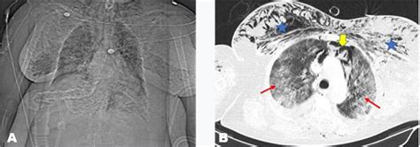 Spontaneous pneumomediastinum COVID-19: Impact of mechanical ventilation - Case Reports ...