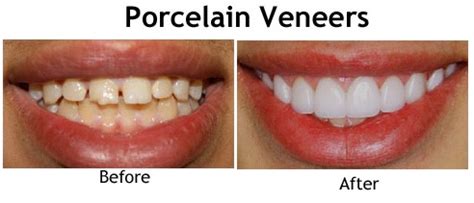 Porcelain Veneers