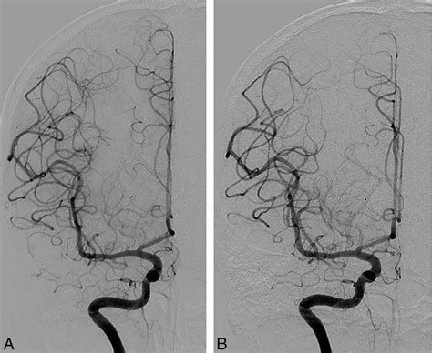 Image Quality of Low-Dose Cerebral Angiography and Effectiveness of Clinical Implementation on ...