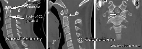 Os Odontoideum - Physiopedia