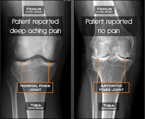 OA knees - Shawe Physio - Physiotherapy, Massage and Personal Training ...