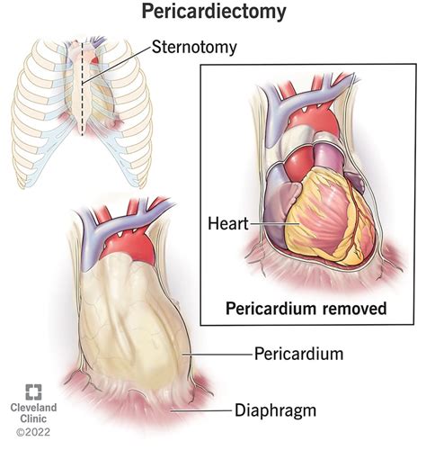 Pericardiectomy: Details, Recovery and Outlook