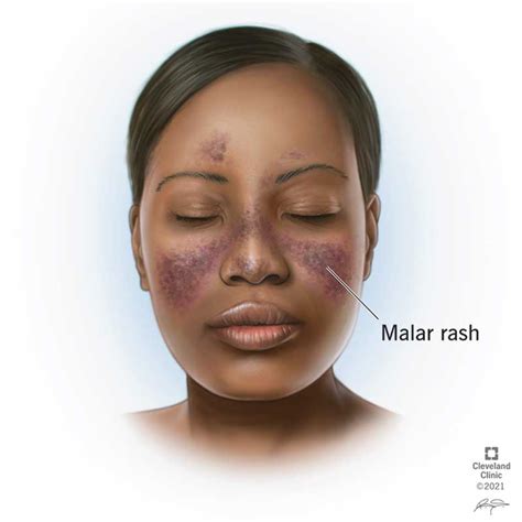 Lupus Rash: Types, Causes, Treatment & Prevention