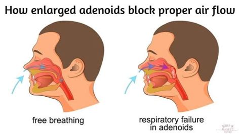 Mouth Breathing in Children – Should You Be Concerned?