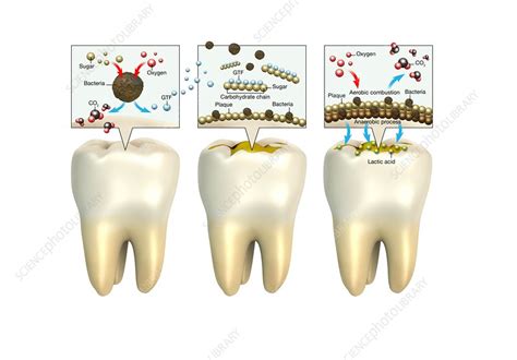 Formation of plaque on teeth, illustration - Stock Image - C047/7643 - Science Photo Library