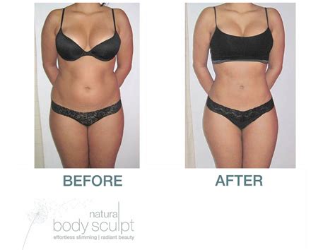 Laser Lipo | Natural Body Sculpt