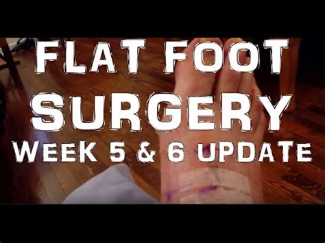 Flat Foot Surgery Recovery: Week 5 & 6 - YouTube