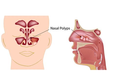 Nasal polyps | ENT Surgeon