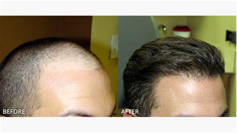 How much does a hair transplant cost? - HazelNews