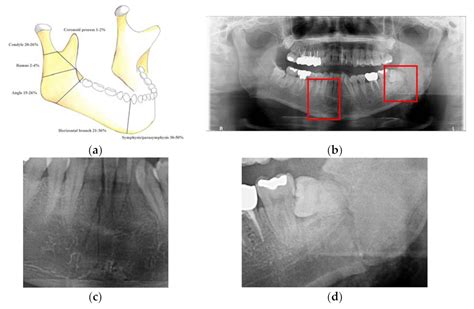 Mandibular Fracture X Ray