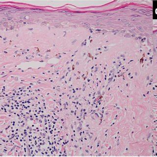 Histopathology of linear discoid lupus erythematosus (a) superficial... | Download Scientific ...