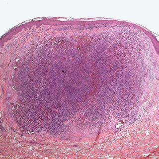 Histology of Classic Kaposi Sarcoma (hematoxylin and eosin, 4X ...