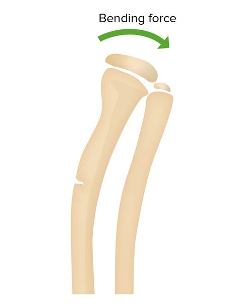 Greenstick Fracture X Ray