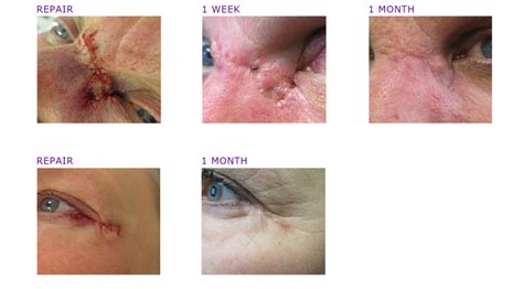 MOHS Surgery Photos | Before & After | ADC Derm