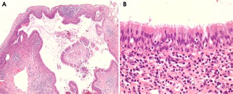 Bilateral postoperative maxillary cysts after orthognathic surgery: A case report