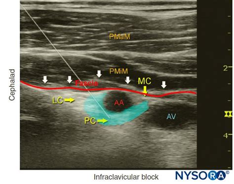 Infraclavicular Brachial Plexus Ultrasound Image Of Infraclavicular | Images and Photos finder