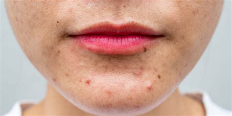 Dry Skin and Acne: Causes and Treatments