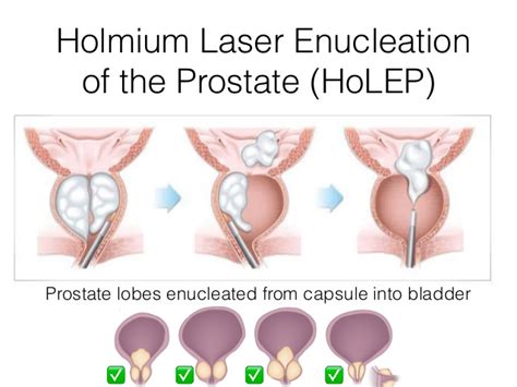 Treatment of BPH - HoLEP - Prostate Matters