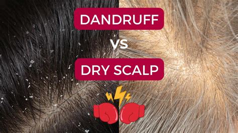 Dandruff vs Dry Scalp: So You Can Better Fight the Itch