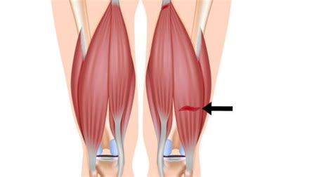 Hamstring Strain - Causes, Treatment & Exercises - Sportsinjuryclinic.net